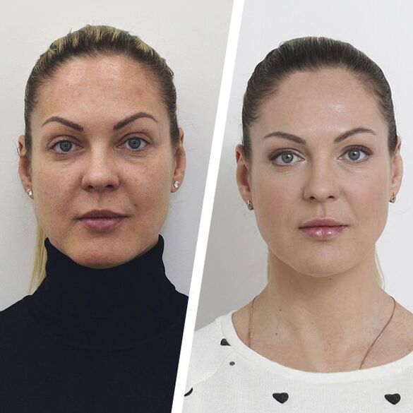 Avant et après le rajeunissement de la peau du visage sans chirurgie