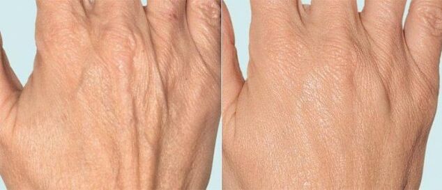 Peau des mains avant et après thérapie fractionnée