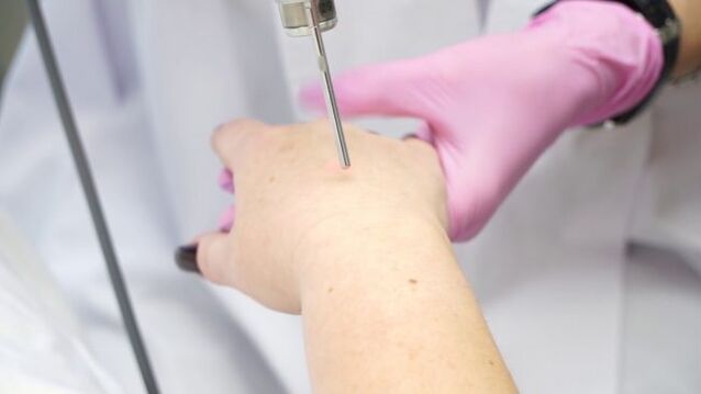 Rajeunissement de la peau des mains au laser