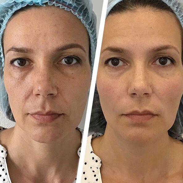 photos de visage avant et après rajeunissement laser